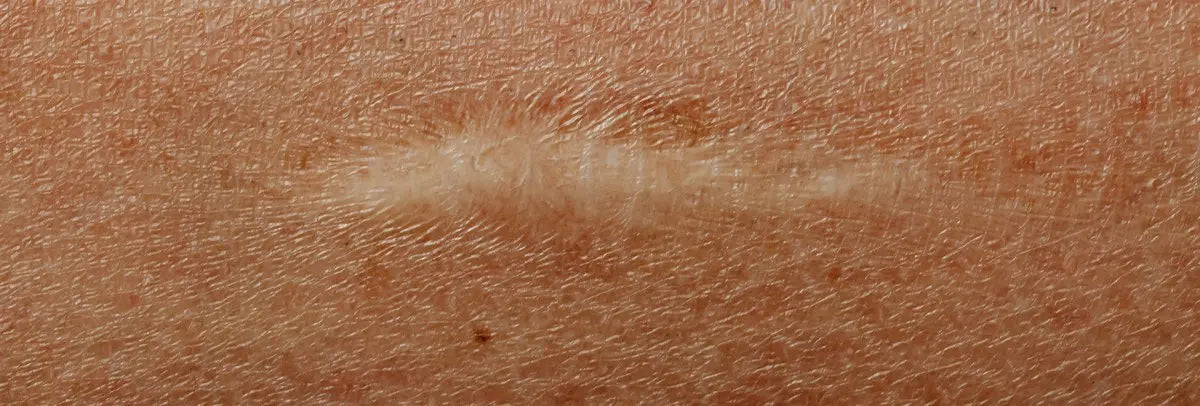 Cicatrices: el miedo a mostrarme tal como soy