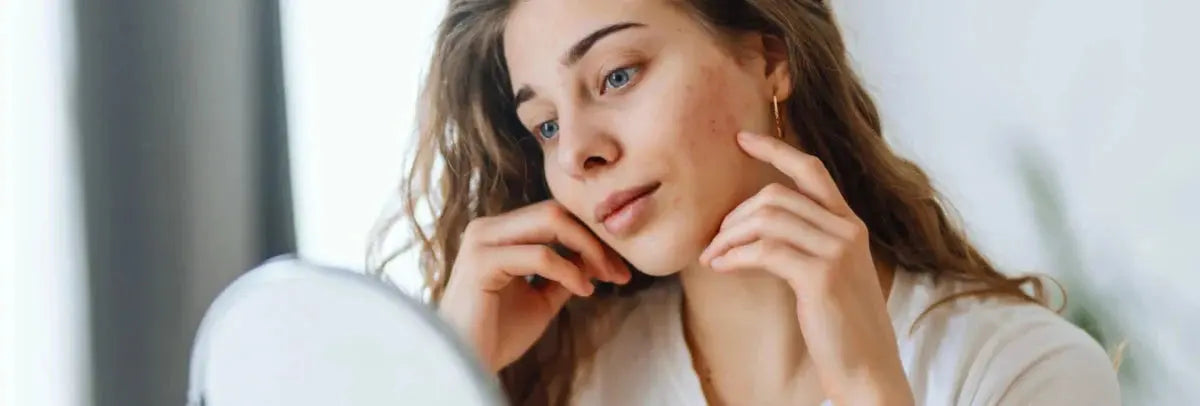 El estrés en tu piel: ¿Cómo se ve? Consejos para combatirlo